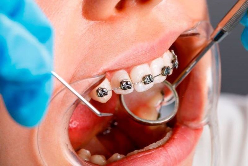 Nha khoa Oxy có thế mạnh về kỹ thuật chỉnh nha