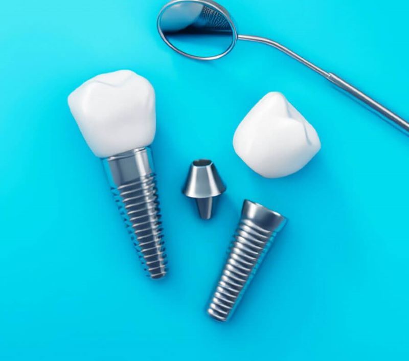 địa chỉ trồng răng implant tốt uy tín Phường Bình Tây TPHCM