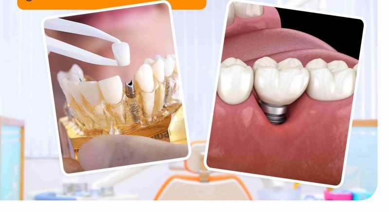 Nha Khoa Hoàng Kim nổi bật phục hình Implant thẩm mỹ