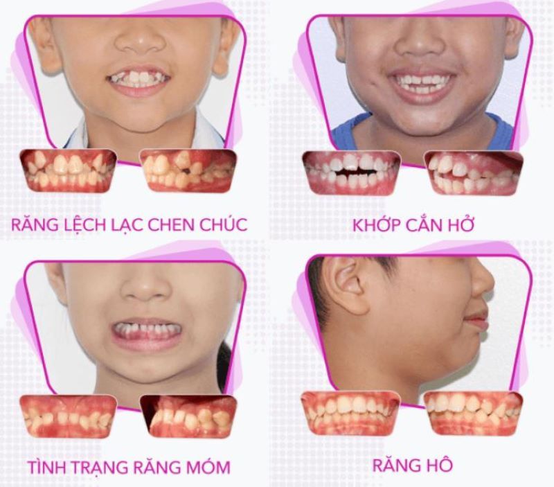 Khí cụ chỉnh nha sớm cho bé 2