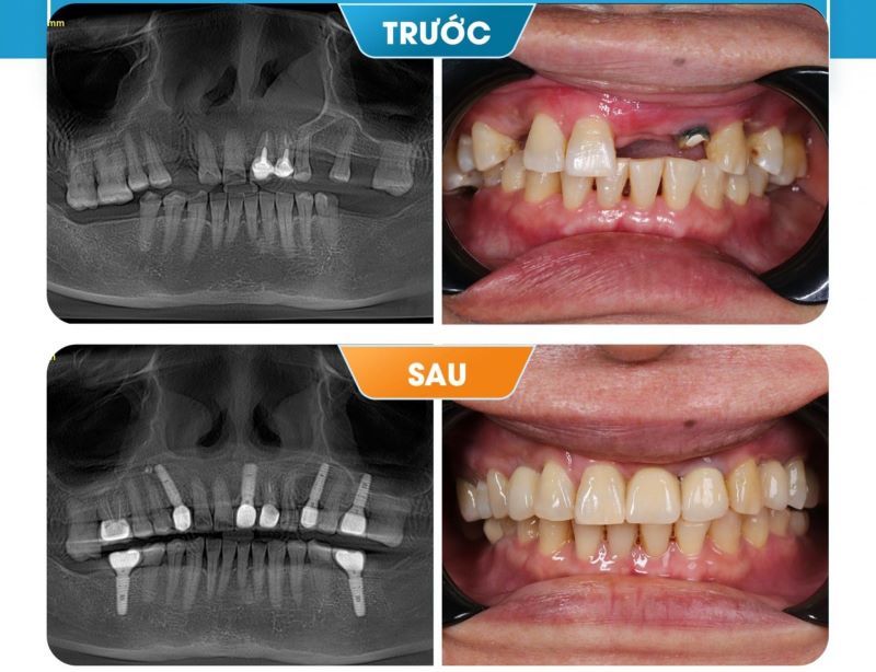 địa chỉ trồng răng implant tốt uy tín Phường Bình Tiên TPHCM