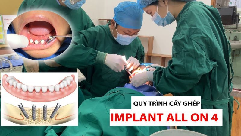 địa chỉ trồng răng implant tốt uy tín Phường Bình Tiên TPHCM 3
