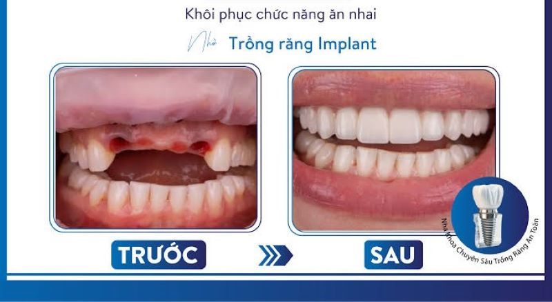 địa chỉ trồng răng implant tốt uy tín Phường Bình Tiên TPHCM 5