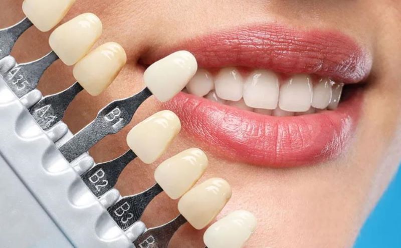 Dịch vụ dán sứ Veneer tinh tế được thực hiện tại Nha khoa Pháp Việt.