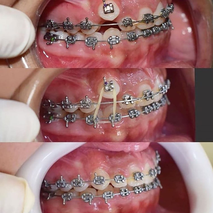 bảng báo giá niềng răng giá rẻ nhất 2025 8