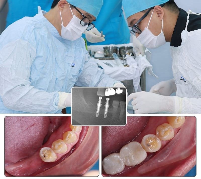 địa chỉ trồng răng implant tốt uy tín Phường Bình Phú TPHCM 2