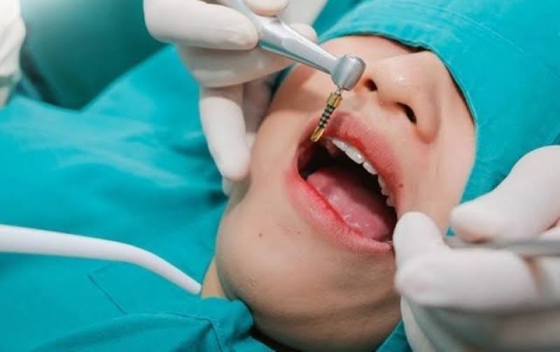 Nha Khoa Shark sử dụng nhiều dòng Implant chính hãng