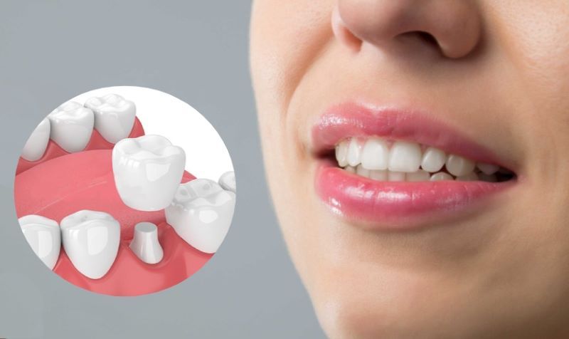 Nha khoa Đại Thành cung cấp dịch vụ bọc sứ thẩm mỹ