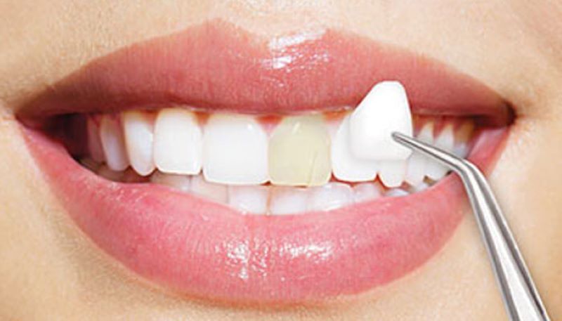 Kỹ thuật dán mặt sứ Veneer tinh tế đem lại nụ cười đẹp tại Nha khoa Việt Nga.