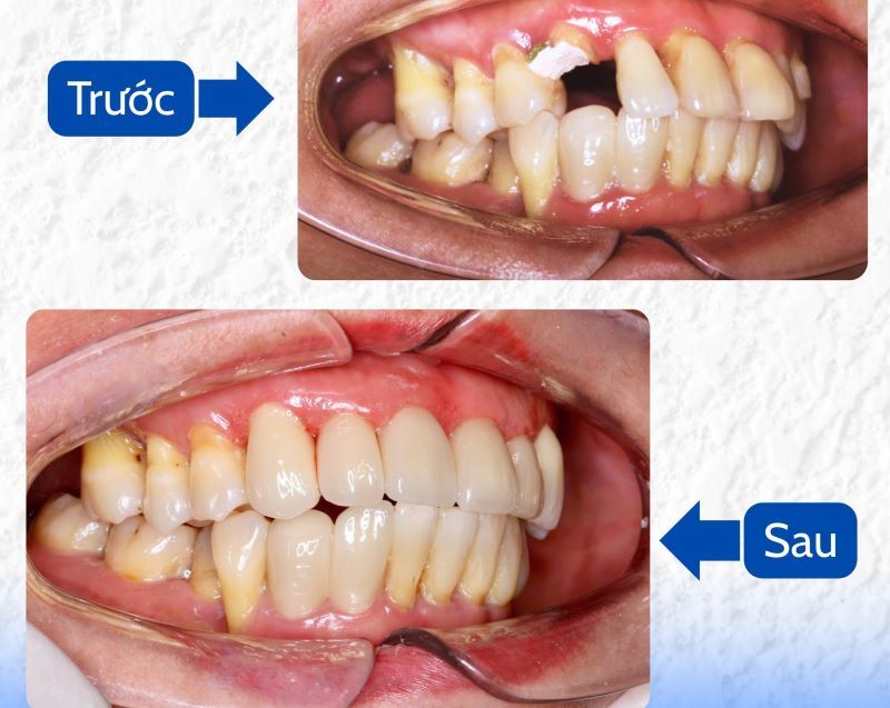 Nha Khoa Gia Đình nổi bật phục hồi răng gãy vỡ