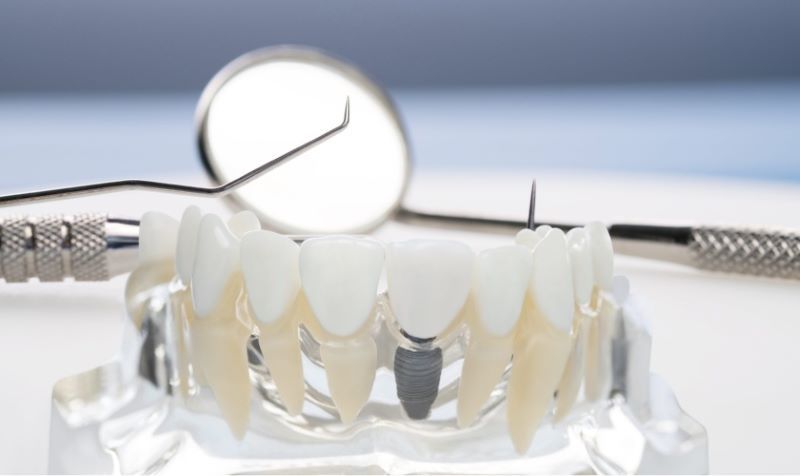 Nha Khoa Sài Gòn Quốc Tế mạnh về cấy ghép Implant