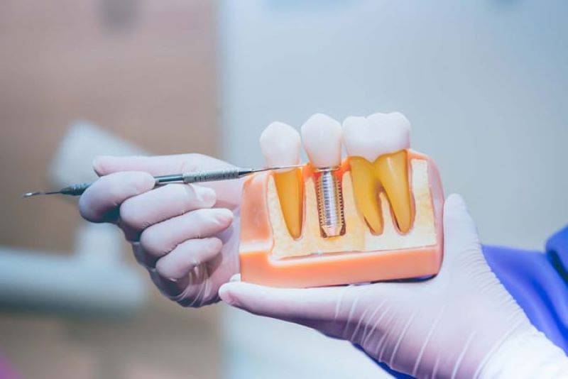 địa chỉ trồng răng implant tốt uy tín Phường Phú Lâm TPHCM 3