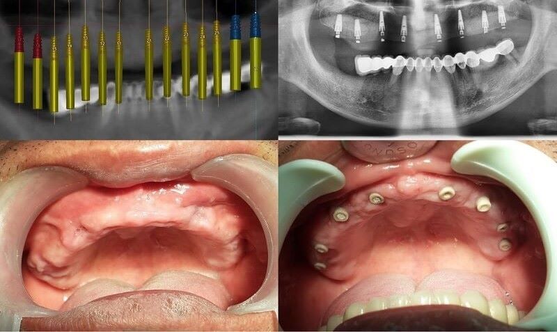 Nha khoa Thanh Phong mạnh về Implant thẩm mỹ