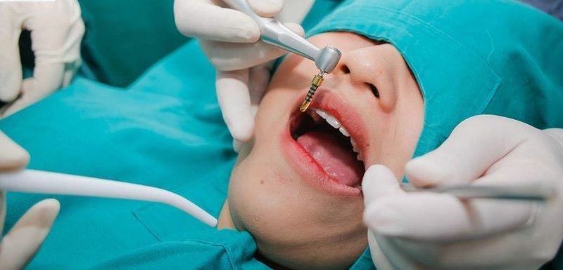 Kỹ thuật phục hình implant tại nha khoa Vidental