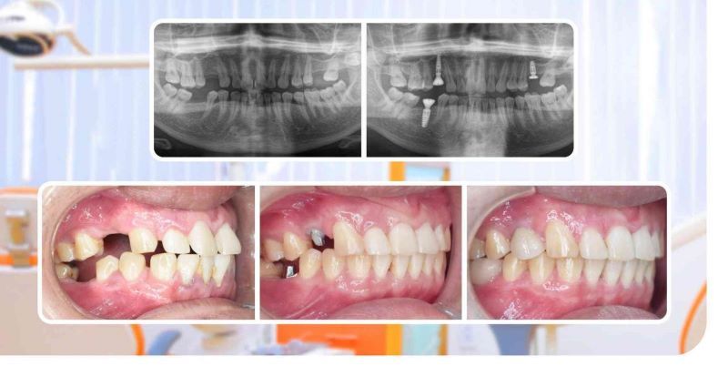 Nha khoa Dr. Care chuyên sâu trong kỹ thuật cấy ghép Implant