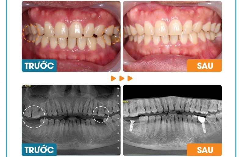địa chỉ trồng răng implant tốt uy tín Phường Phú Thuận TPHCM