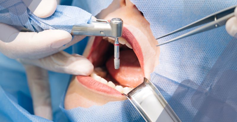 Nha Khoa Nhân Ái nổi bật với dịch vụ cấy ghép implant 