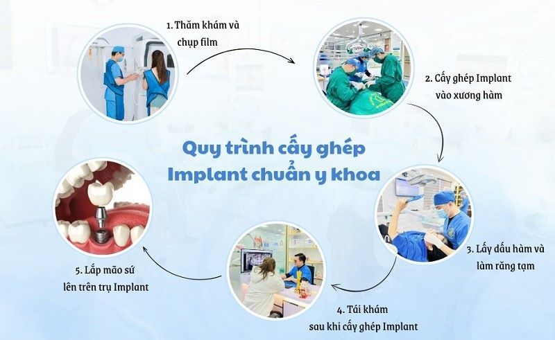 địa chỉ trồng răng implant tốt uy tín Phường Tân Mỹ TPHCM