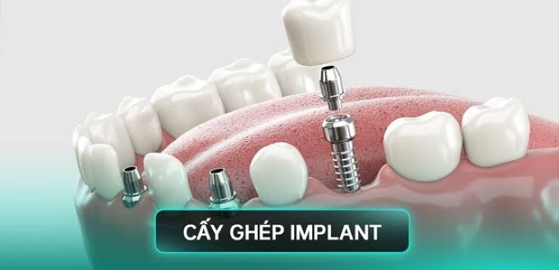 địa chỉ trồng răng implant tốt uy tín Phường Tân Mỹ TPHCM 2