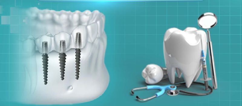 Nha Khoa Happy nổi bật với chi phí trồng implant hợp lý