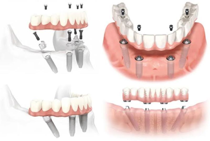 địa chỉ trồng răng implant tốt uy tín Phường Tân Hưng TPHCMc 4