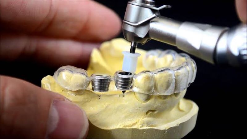 Nha Khoa Việt Mỹ nhiều năm kinh nghiệm phục hình răng