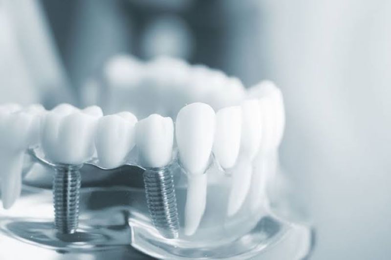 địa chỉ trồng răng implant tốt uy tín Phường Chánh Hưng TPHCM 2