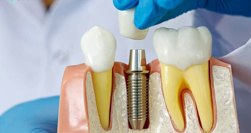địa chỉ trồng răng implant tốt uy tín Phường Phú Định TPHCM