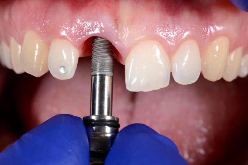 địa chỉ trồng răng implant tốt uy tín Phường Phú Định TPHCM 3