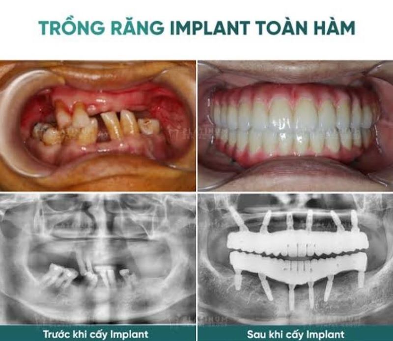 địa chỉ trồng răng implant tốt uy tín Phường Phú Định TPHCM 4
