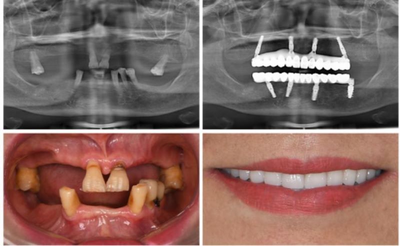 địa chỉ trồng răng implant tốt uy tín Phường Bình Đông TPHCM 4