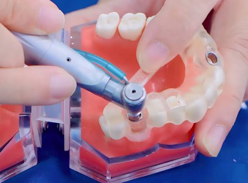 địa chỉ trồng răng implant tốt uy tín Phường Vườn Lài TPHCM 2