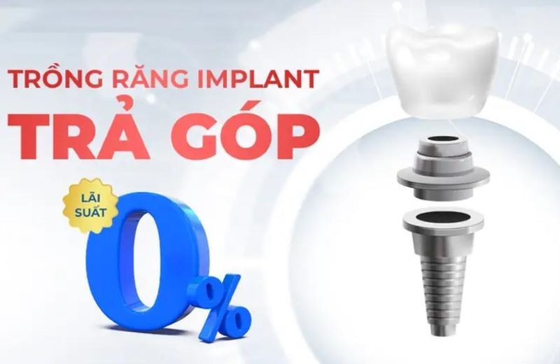 địa chỉ trồng răng implant tốt uy tín Phường Vườn Lài TPHCM 4