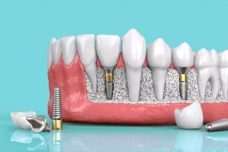 Nha khoa Elite đạt tỷ lệ cấy ghép Implant thành công cao