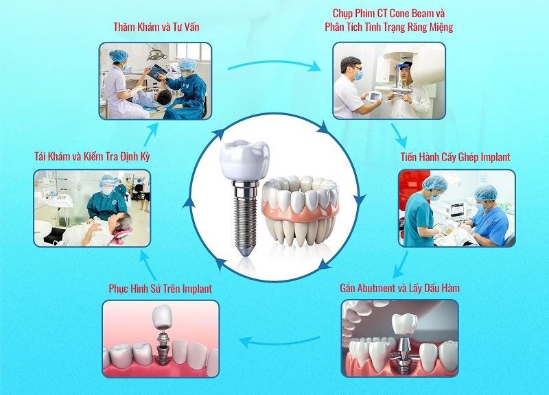 Dr.Care nổi bật với quy trình Implant 12 tiêu chuẩn