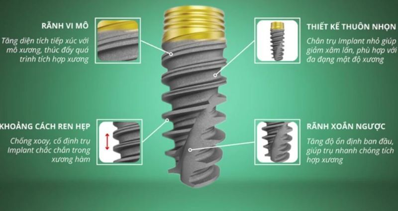 Nha khoa Vinh An sử dụng trụ Titanium tích hợp xương tốt