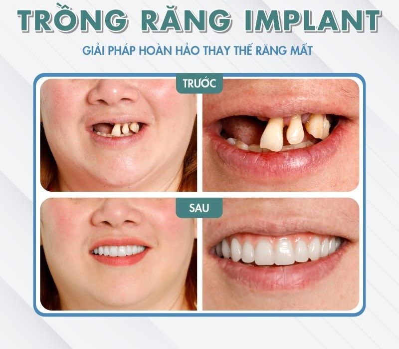 địa chỉ trồng răng implant tốt uy tín Phường Bình Thới TPHCM