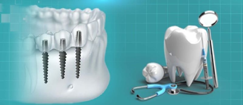 địa chỉ trồng răng implant tốt uy tín Phường Bình Thới TPHCM 2