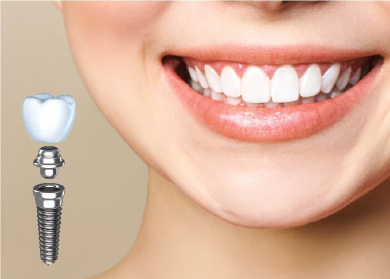 địa chỉ trồng răng implant tốt uy tín Phường Bình Thới TPHCM 3