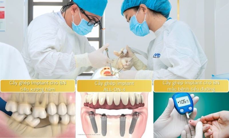 Thế mạnh của nha Khoa Ocare là xử lý nhiều ca Implant khó