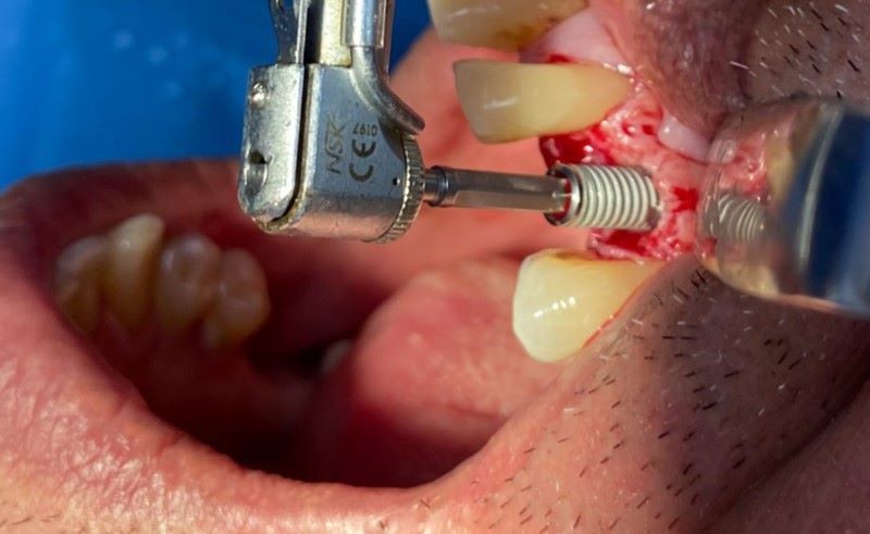 Địa chỉ trồng răng implant tốt uy tín Phường Hòa Bình TPHCM 2