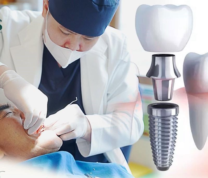 Nha Khoa Dr.Care chuyên ghép trụ Implant cho người trung niên