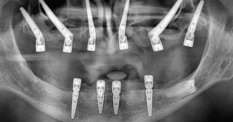 địa chỉ trồng răng implant tốt uy tín Phường Phú Thọ TPHCM 5