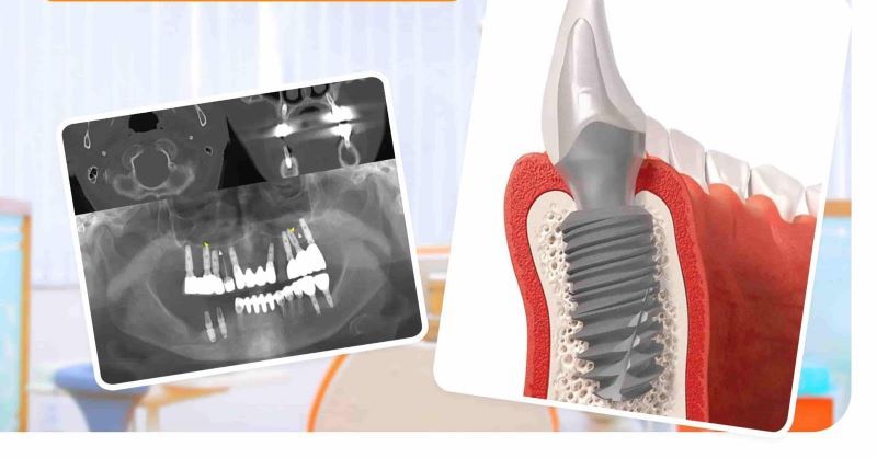 địa chỉ trồng răng implant tốt uy tín Phường Phú Thọ TPHCM 8