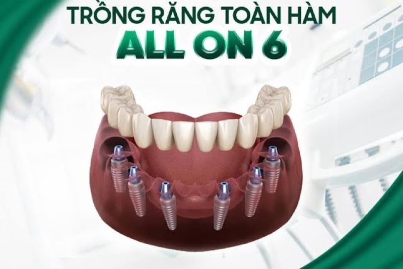 Nha khoa Platinum Dental chuyên sâu kỹ thuật trồng răng toàn hàm phức tạp