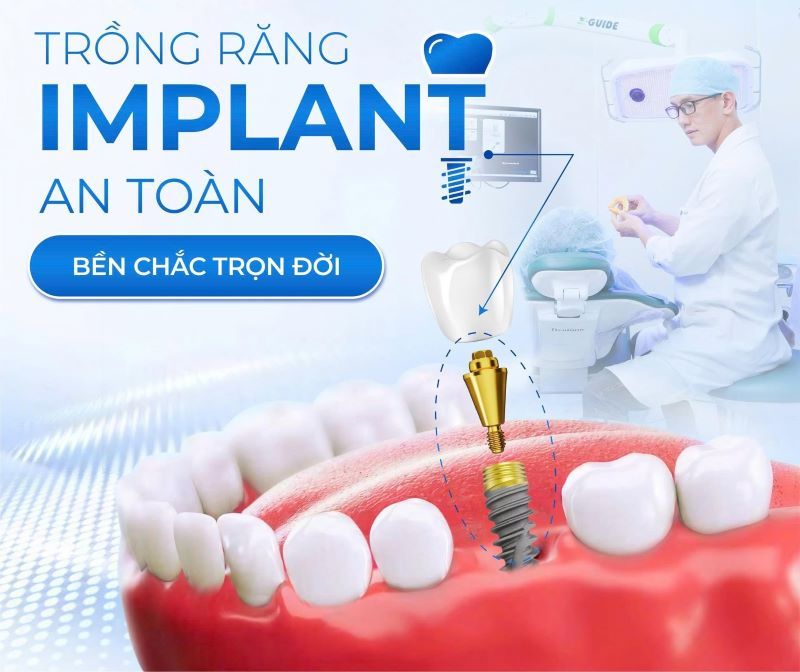 địa chỉ trồng răng implant tốt uy tín Phường Trung Mỹ Tây TPHCM