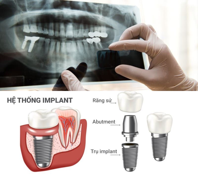 địa chỉ trồng răng implant tốt uy tín Phường Trung Mỹ Tây TPHCM 2