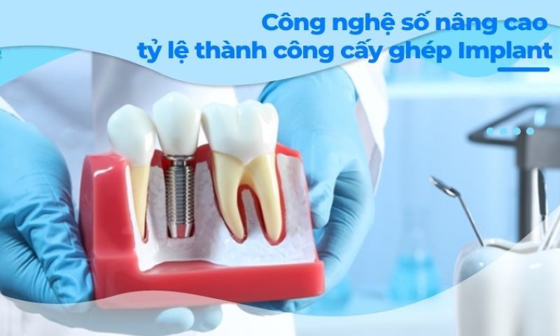 địa chỉ trồng răng implant tốt uy tín Phường Trung Mỹ Tây TPHCM 4