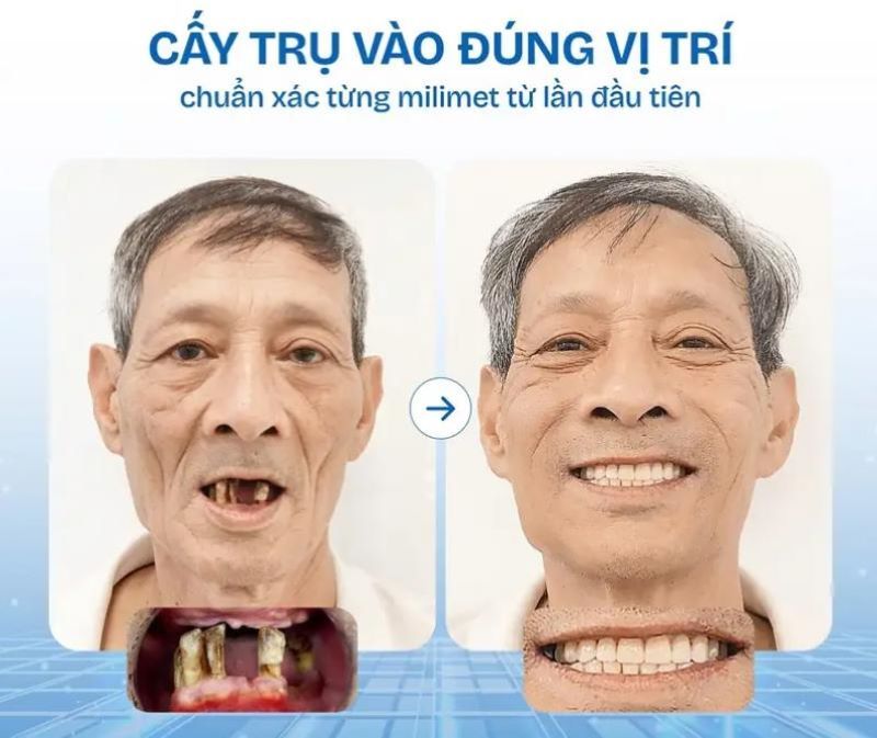 Nha khoa Nhân Tâm điều trị nhiều ca Implant tiêu xương
