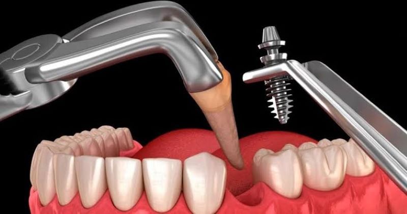Trụ Implant chính hãng tại Nha Khoa Hoa Kỳ tích hợp xương tốt